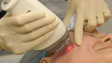 Como se realiza o rexuvenecemento cutáneo fraccionado