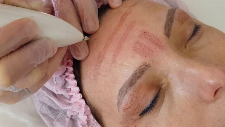 Rexuvenecemento facial con plasma