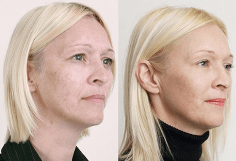 Peeling medio con ácidos de froitas